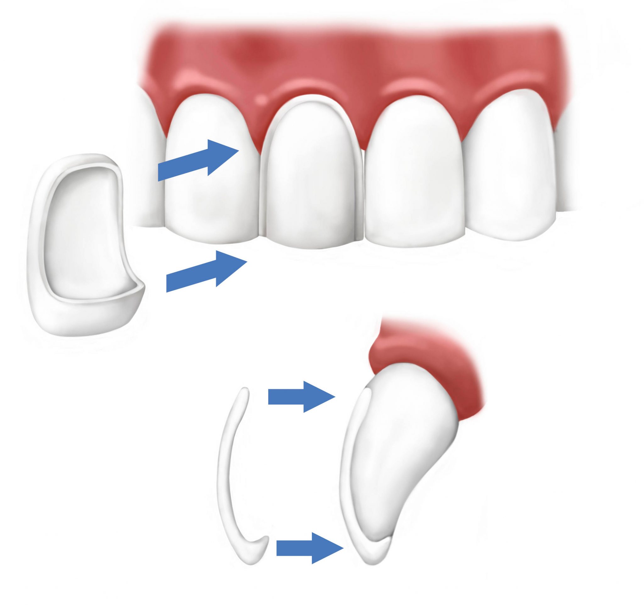 Pose Facette Dentaire Tunisie, Prix Pas Cher! Tout savoir: Tarifs € Photos  Dentiste