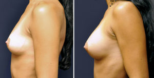 Lipofilling mammaire Tunisie Lipofilling mammaire Tunisie