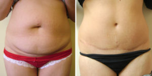 Abdominoplastie et mini-lift abdominal Tunisie : chirurgie réparatrice du ventre Abdominoplastie et mini-lift abdominal Tunisie : chirurgie réparatrice du ventre