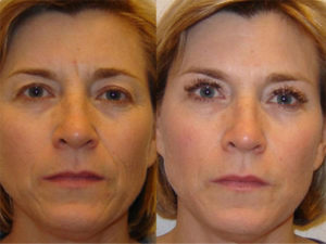 Lipofilling du visage Tunisie Lipofilling du visage Tunisie