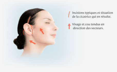 lifting-cervico-facial en Tunisie : Déroulement de l'opération