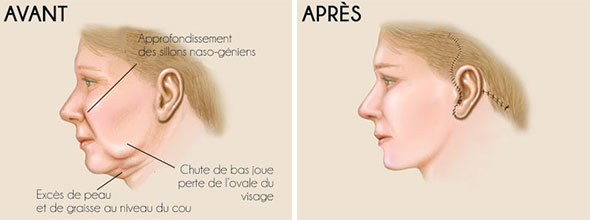 lifting visage Tunisie