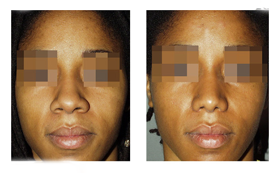 rhinoplastie ethnique avant après