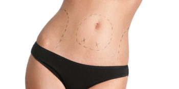 Chirurgie de l'abdomen et contraception : sécuriser votre parcours opératoire