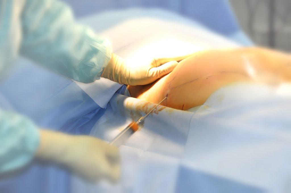 Reinjection graisse : Opération tendance de chirurgie Reinjection graisse : Opération tendance de chirurgie