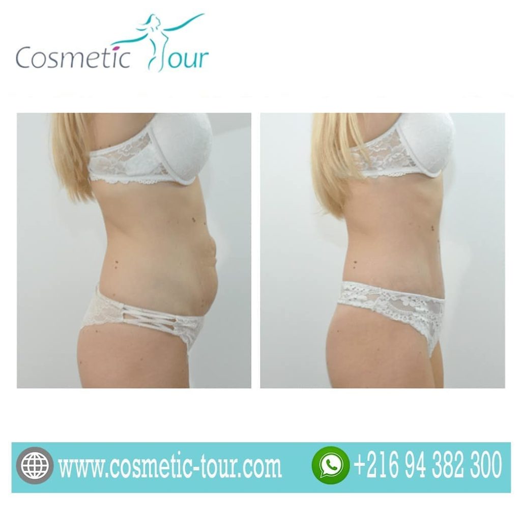 abdominoplastie avant après dans le cadre d'une opération mommy makeover en Tunisie