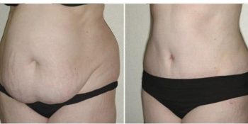 Comment dégonfler le ventre après une abdominoplastie ?