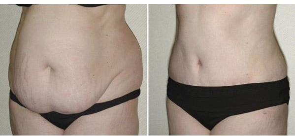 Comment dégonfler le ventre après une abdominoplastie ?