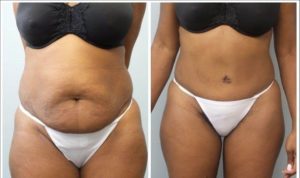abdominoplastie avant apres