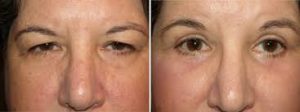 blepharoplastie avant apres