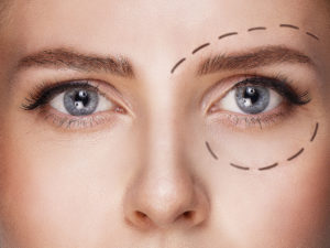 Blepharoplastie Tunisie