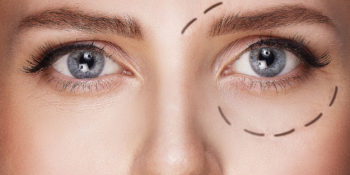 Chirurgie des paupières et rayons UV : Comment sécuriser votre cicatrisation ?