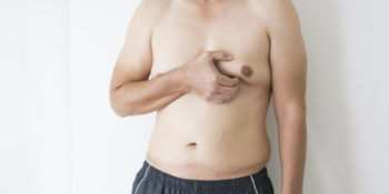 Adipomastie : traiter la gynécomastie graisseuse chez l’homme par liposuccion