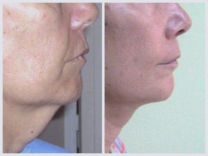 Lifting visage avant apres