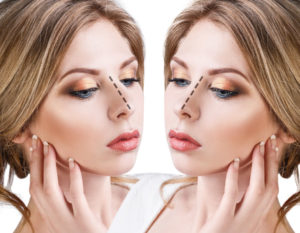 rhinoplastie avant apres