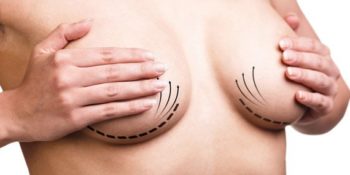 Choisir un bonnet C : pourquoi c’est la taille la plus demandée en chirurgie mammaire