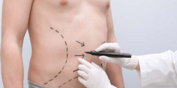 Liposuccion chez l’homme : une solution efficace pour remodeler la silhouette