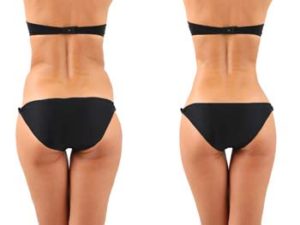 smartlipo Tunisie