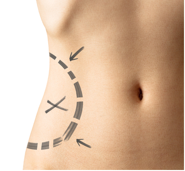 vaser lipo Tunisie