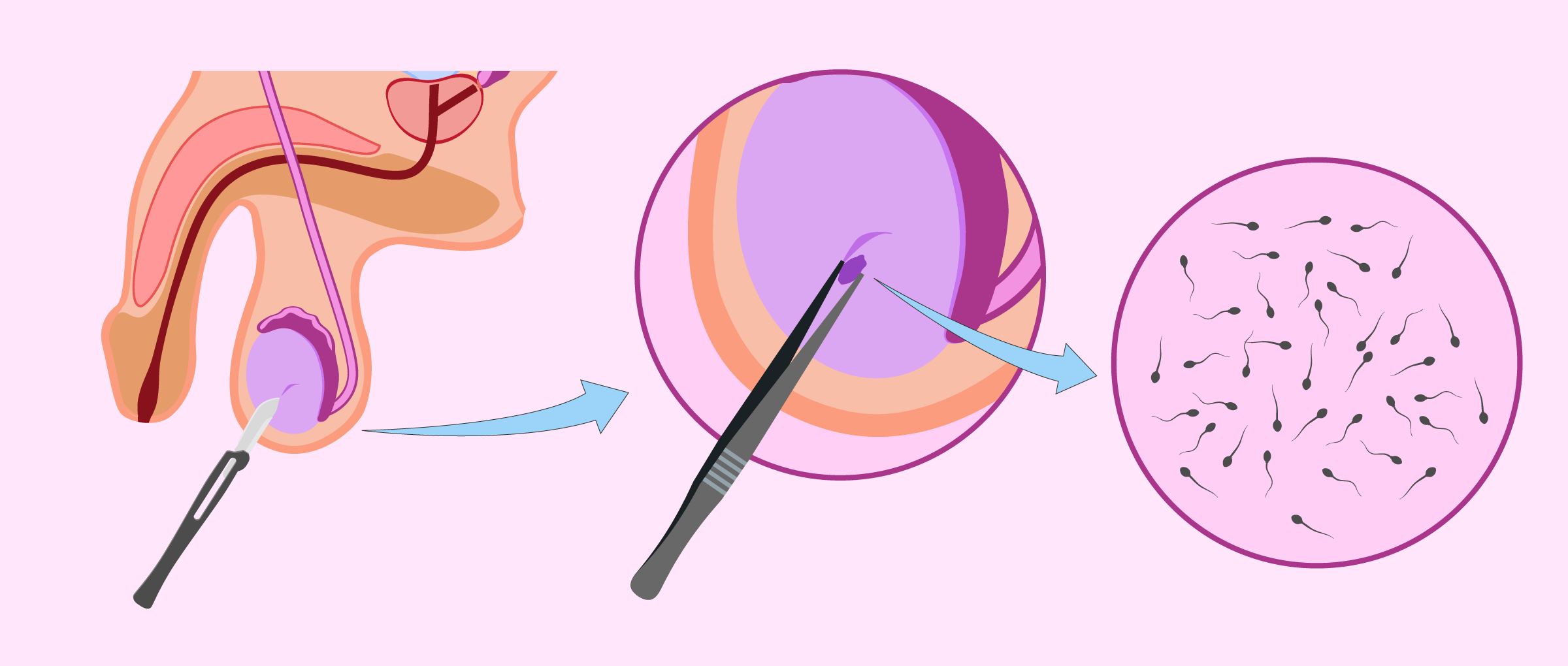 Biopsie testiculaire Tunisie : prélèvement chirurgical sperme