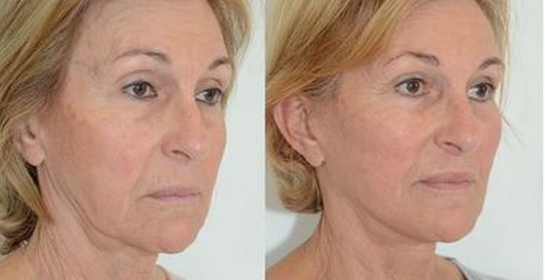 lifting cervico facial prix