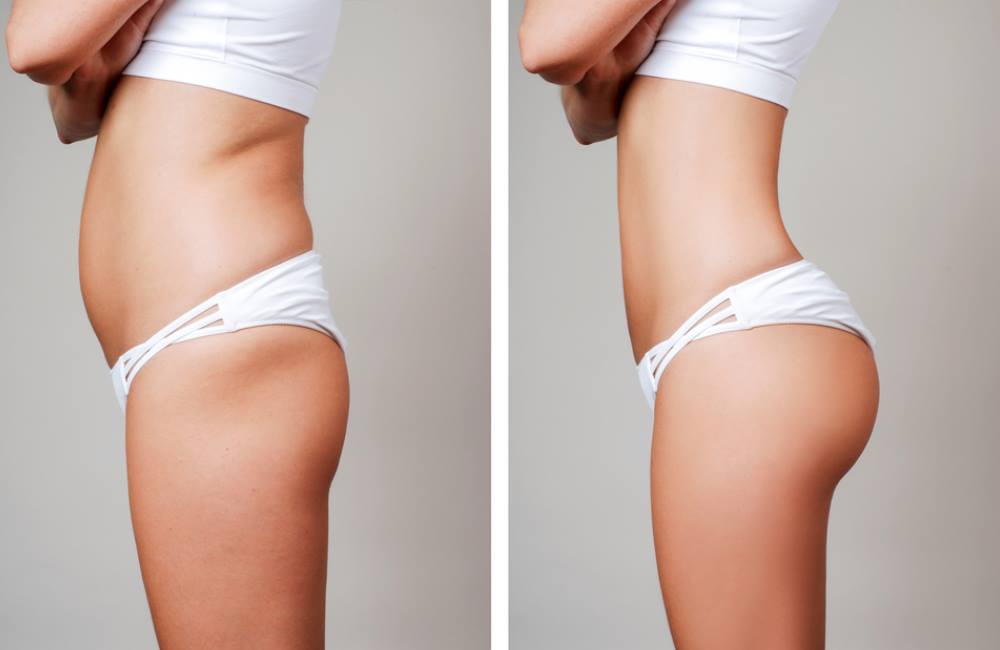 lipofilling fesses avant apres