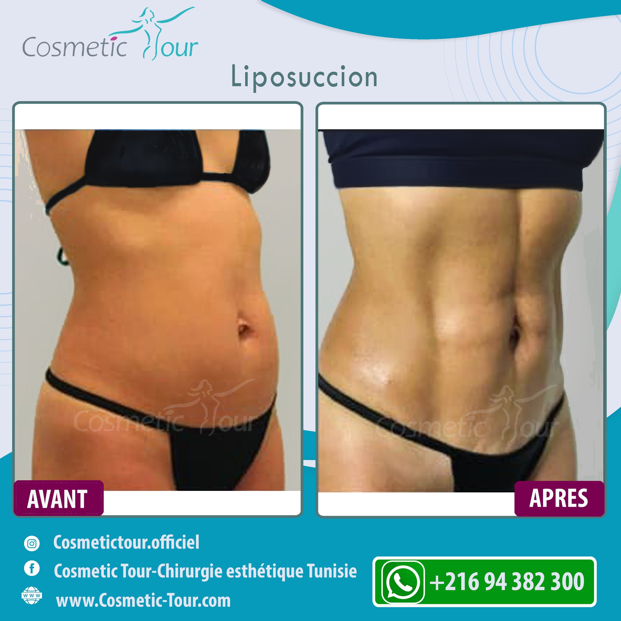 Liposuccion Tunisie meilleur chirurgien | Cosmetic Tour