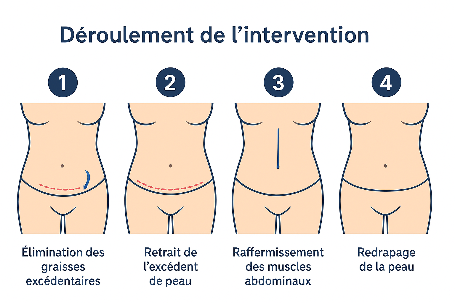 Déroulement d'une abdominoplastie
