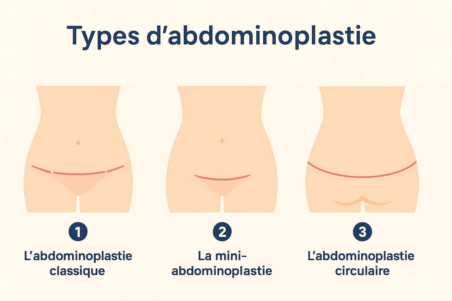 Déroulement d'une abdominoplastie