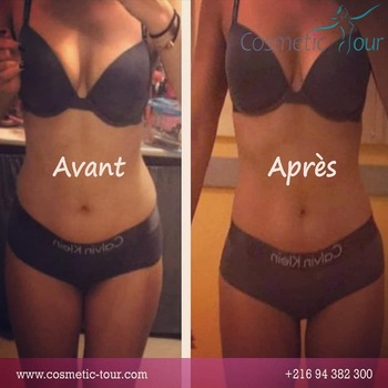 liposuccion femme avant et après