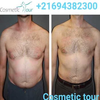 liposuccion homme avant-après