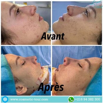 Rhinoplastie avant et après : Il s'agit d'une correction de profil classique. La bosse dorsale (le "bump") a été retirée pour créer une ligne droite. La pointe, qui tombait légèrement, a été remontée (rotation) pour ouvrir l'angle naso-labial.
