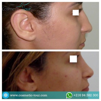 Rhinoplastie de réduction : Adoucissement des traits - Photo avant et après
