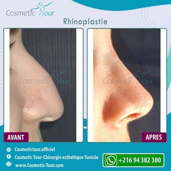 Rhinoplastie avant et après : Suppression de bosse et harmonisation du profil
