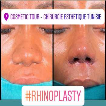 rhinoplastie avant et après : vue basale avant et après (du dessous). On remarque clairement un affinement de la pointe nasale qui est passée d'une forme plus large/arrondie à une forme plus triangulaire et définie. Les narines ont également été réduites (alarplastie).