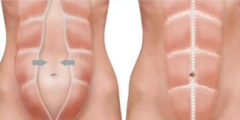 Diastase des muscles grands droits