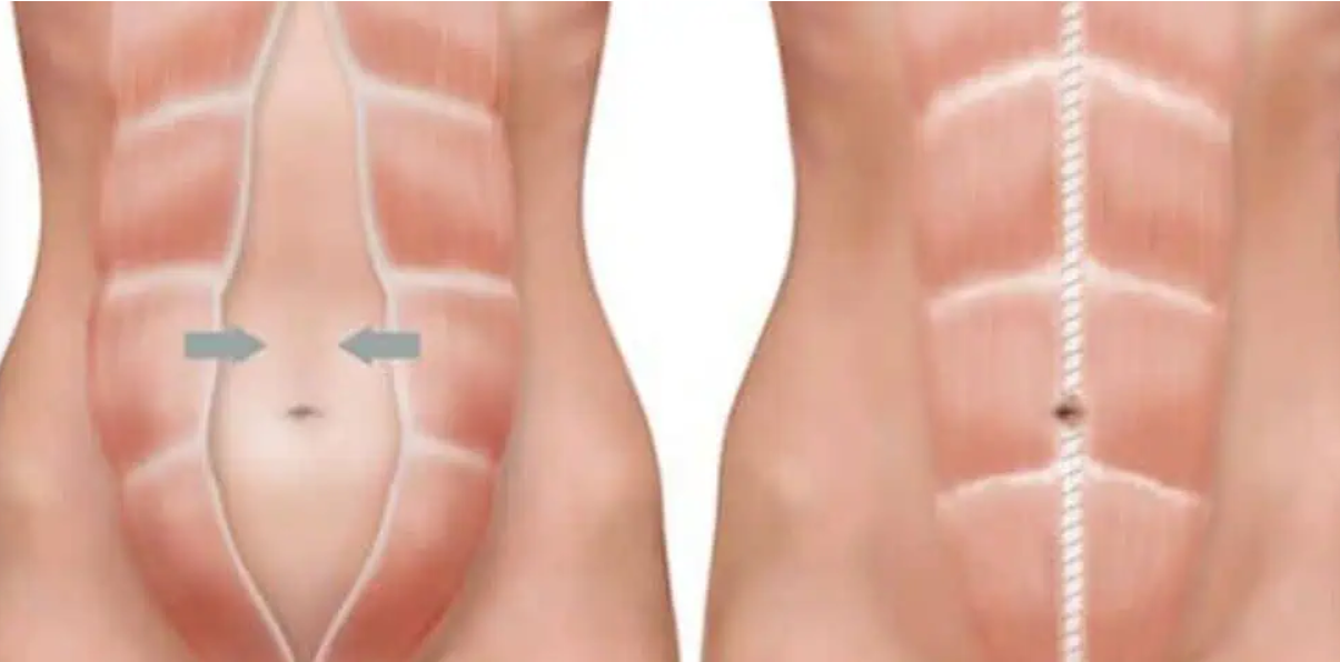 diastasis